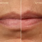 Lip Filler - Image 2